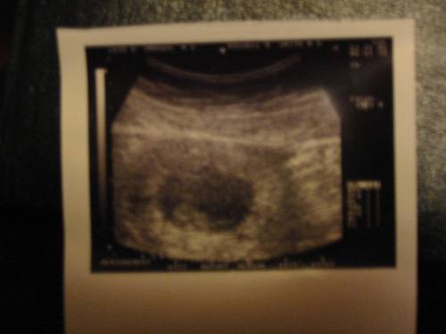 Ultrasound of the new one.